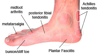 common foot pain after running