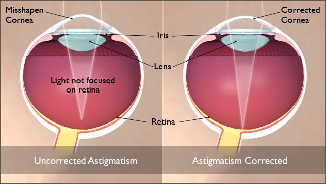 What Is Astigmatism And How To Fix It Guides And Videos What Is Astigmatism And How To Fix It Guides And Videos