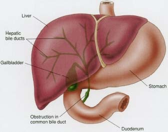 bile duct obstruction after liver transplant