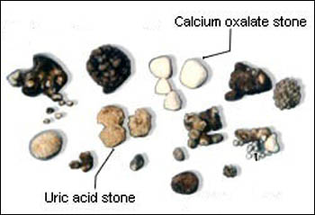 Kidney stones types and sizes