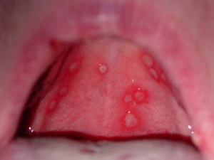 what causes soreness in the roof of your mouth