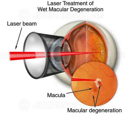 In laser photocoagulation treatment of damp AMD, a laser is utilized to destroy and seal new members vessels to avoid leak and more damage to the retina.