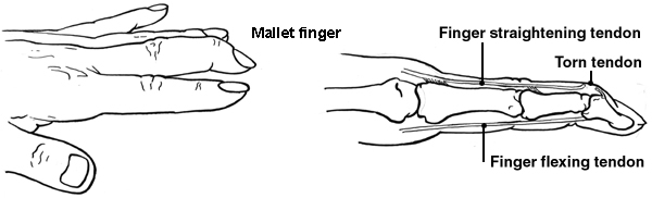 mallet finger arthritis