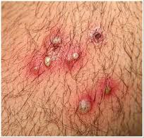 Herpes Zoster Picture Image on MedicineNet.com