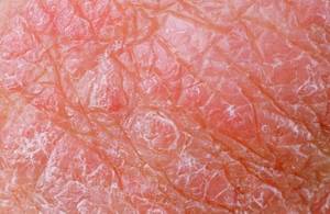 Common Causes Of Red Dry Burning Itchy Scrotum Common Causes Of Red Dry Burning Itchy Scrotum