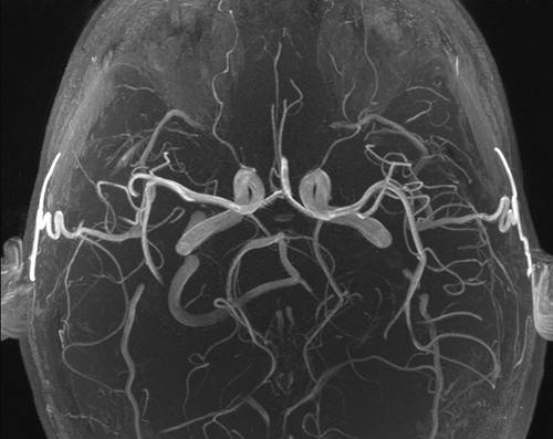 what does mri show in brain blood vessels