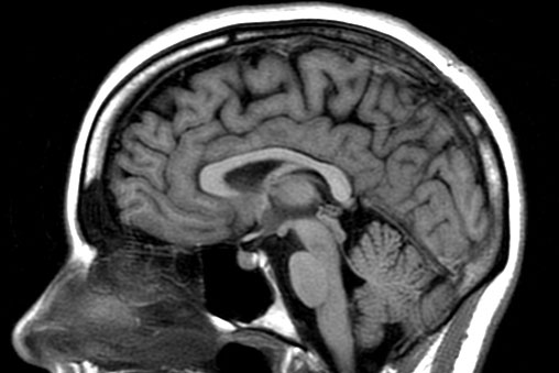 what does mri show in brain?