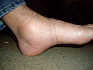 ankle arthritis and running