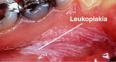 leukoplakia cheek erythroplakia cause iytmed chewing