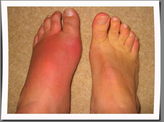 swelling of left foot
