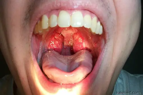 strep pictures Adult throat