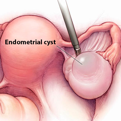 Endometriosis ovarian cysts