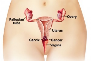 Image of cervical cancer