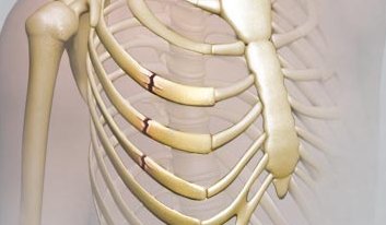 Broken rib treatment tips