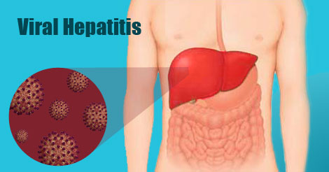 Viral hepatitis and White Stool Color