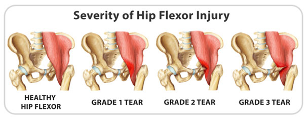 hip flexor strain symptoms
