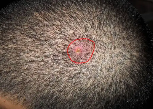 Cancerous Lumps On Scalp IYTmed