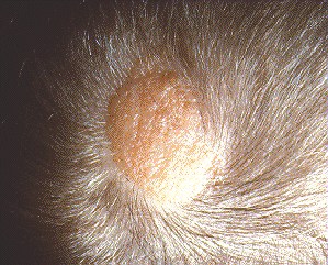 Cancerous Lumps on Scalp
