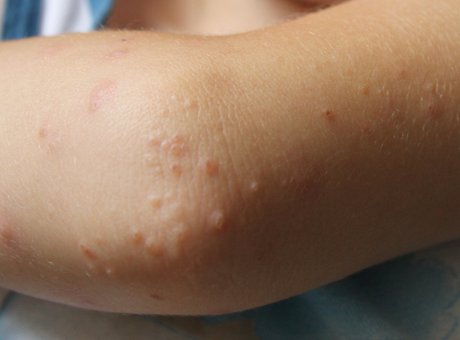 Causes of Small Raised Bumps on Elbows | IYTmed.com