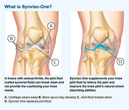 Side Effects of Using Synvisc