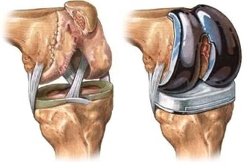 total knee replacement precautions handout