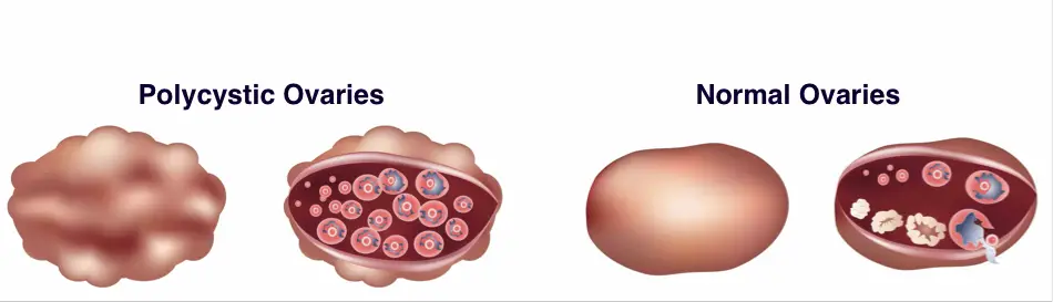 Polycystic Ovary Syndrome PCOS Causes Symptoms And Treatment 