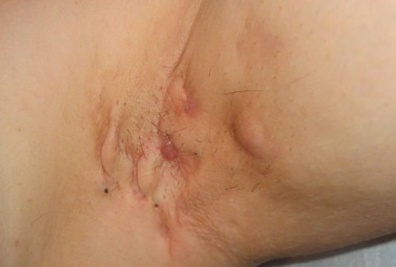 rash under armpit causes & remedy