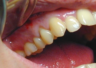 pain relief for severe gum infection
