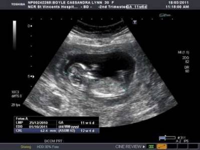 Pregnancy Ultrasound Pictures 12 Weeks