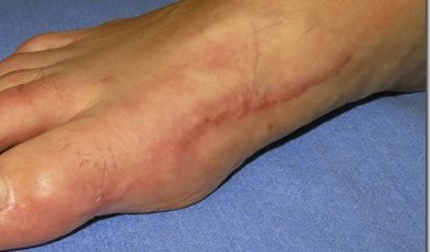Scar tissue on foot (image)