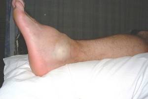 Left Leg Swelling
