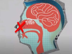 Anosmia Causes Complications And Treatment IYTmed