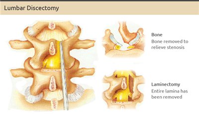 recovery after microdiscectomy surgery