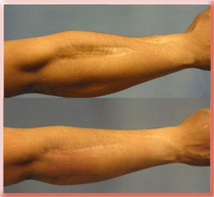 Best Scar Treatment After Surgery: What You Should Know