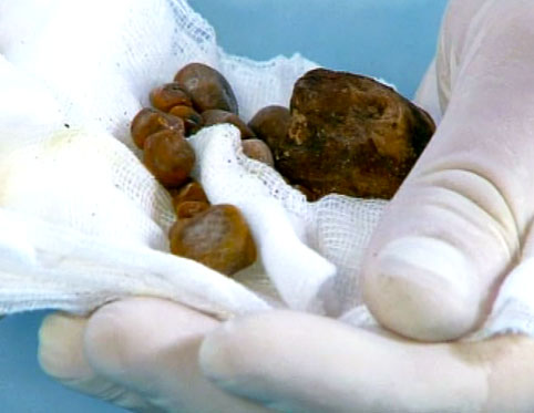 gallstones from gallbladder after surgery