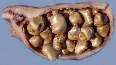 gallstones in gallbladder