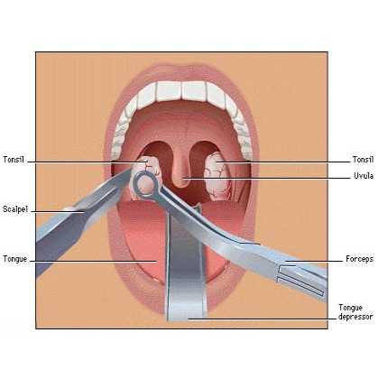 tonsillitis surgery procedure 