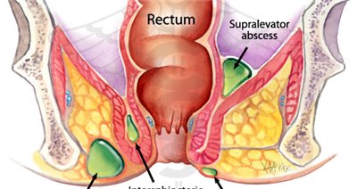 rectal fistula surgery recovery