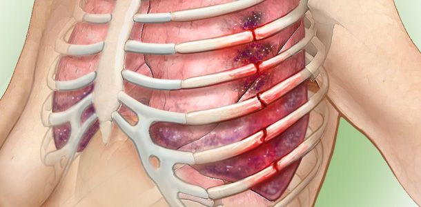 Rib fracture healing process