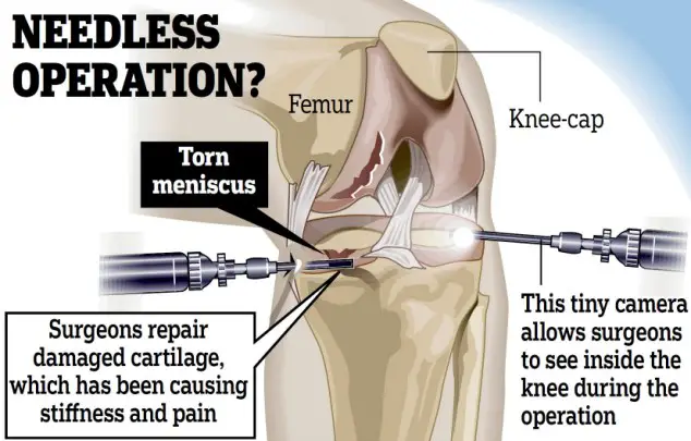 knee cartilage surgery procedure