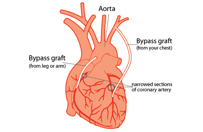 Heart bypass image
