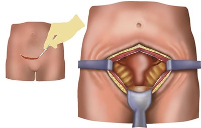 hysterectomy operation image