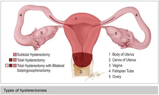 Types of hysterectomies