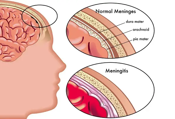 meningitis symptoms and pictures