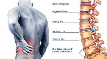 right side back pain after exercise