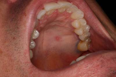 The roofing of your mouth, or the hard palate, may bother you or cause issues, such as swelling or inflammation and be rather uncomfortable. On Image you can see a roof of mouth swelling behind front teeth