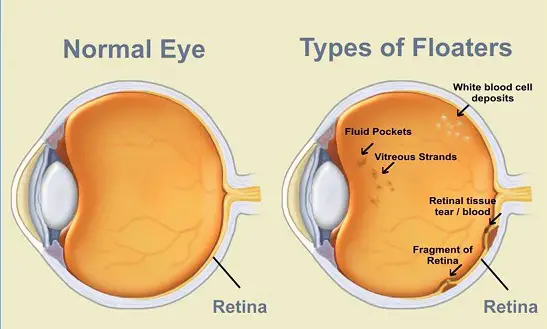 eye floaters blurred vision