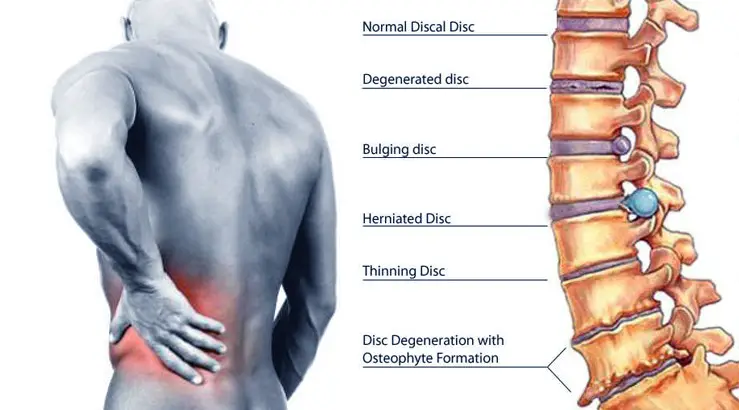 best treatment for lower back pain ice or heat