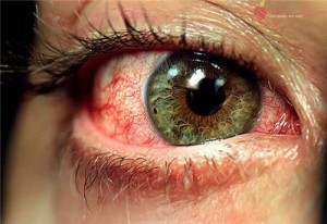 Burning Eyes: Causes And Treatment