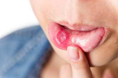 mouth ulcers causes and treatment